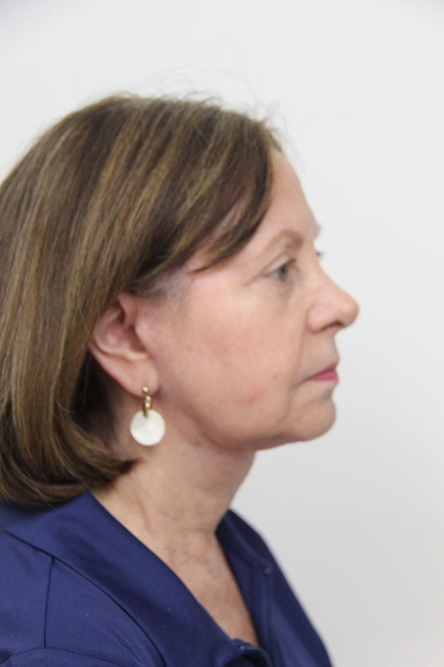 Case--2520 | After Eyelid Surgery / Blepharoplasty 3
