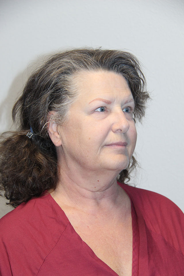 Case--3840 | Before Eyelid Surgery / Blepharoplasty 2