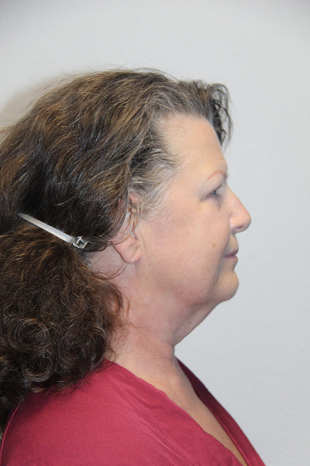 Case--3840 | Before Eyelid Surgery / Blepharoplasty 3