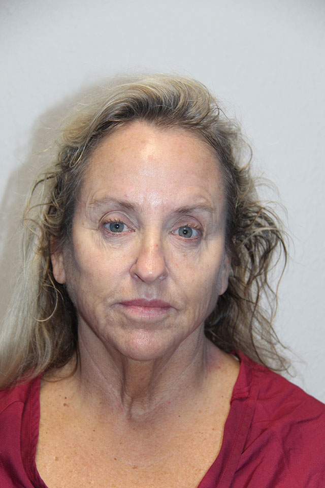 Case--6812 | Before Eyelid Surgery / Blepharoplasty 1
