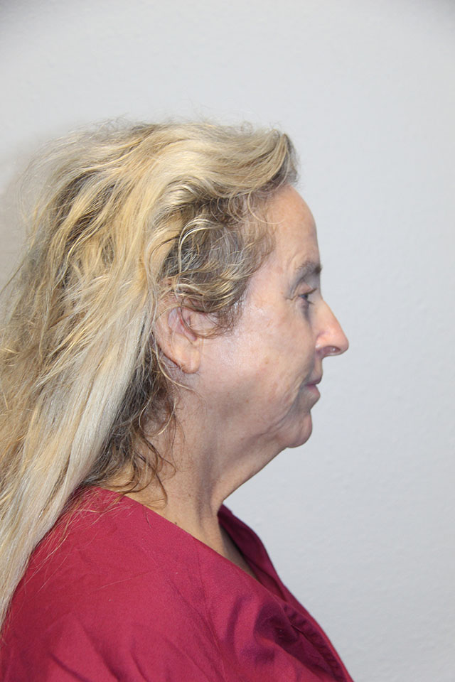 Case--6812 | Before Eyelid Surgery / Blepharoplasty 2