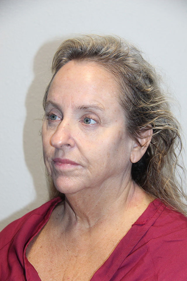 Case--6812 | Before Eyelid Surgery / Blepharoplasty 3