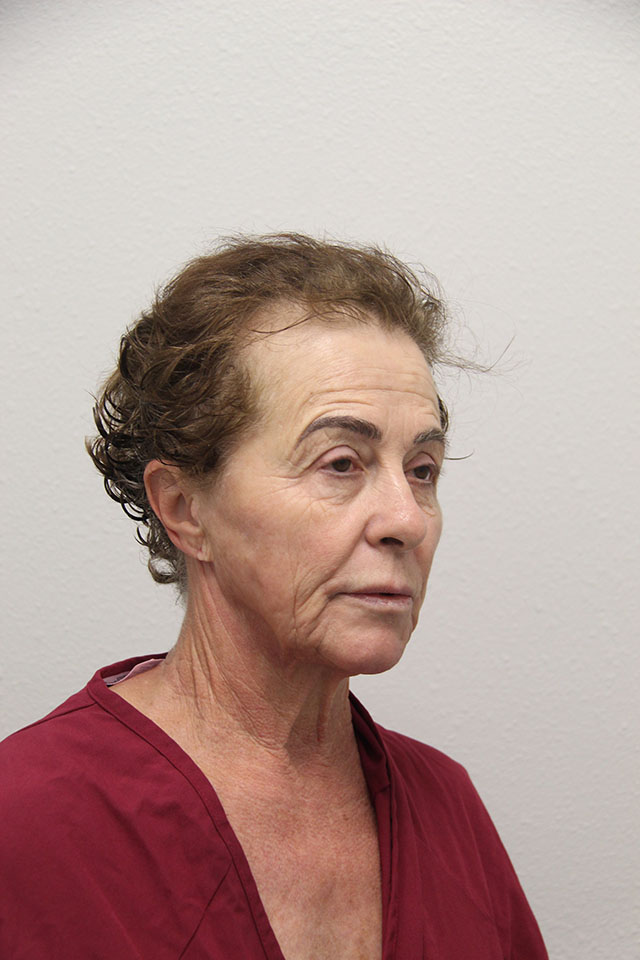 Case--7146 | Before Fat Injection to the Face 2