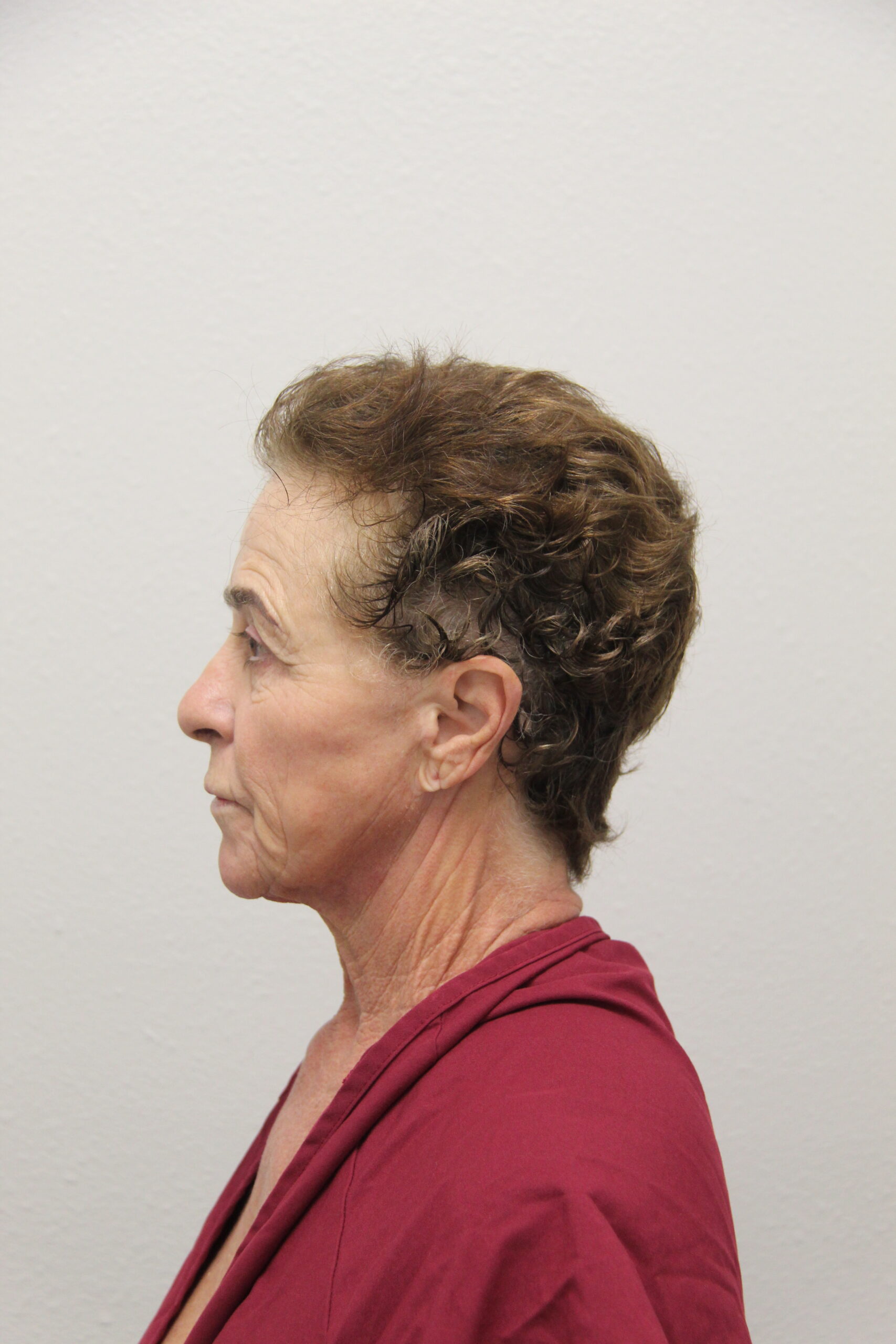 Case--7146 | Before Fat Injection to the Face 4