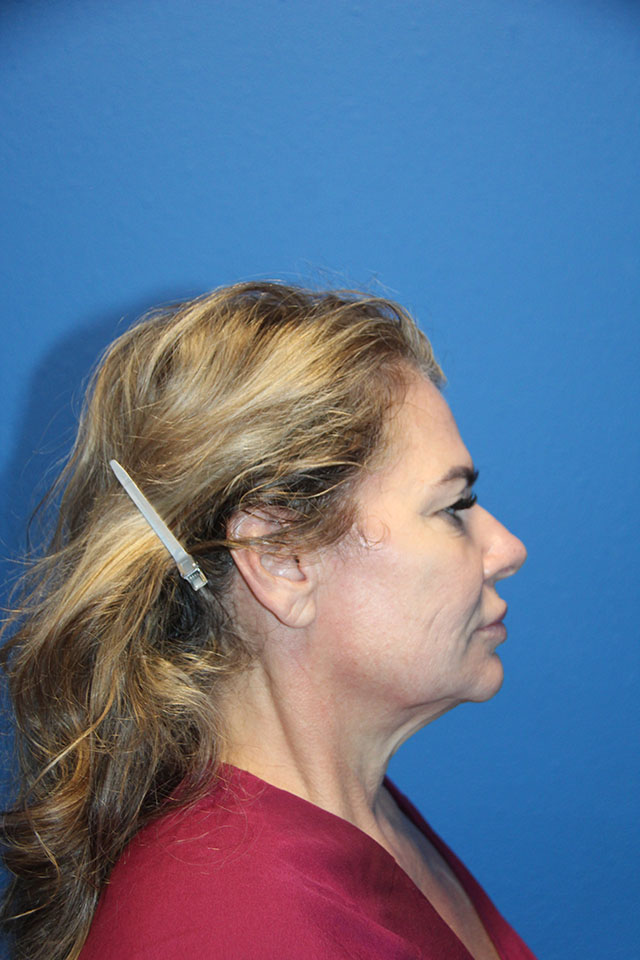 Case--6127 | Before Cheek Lift 2
