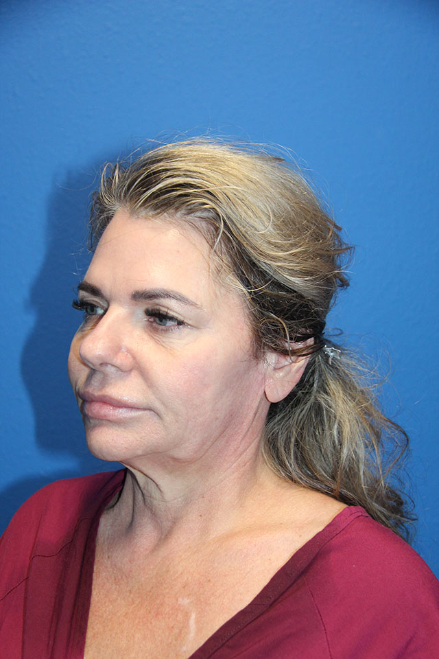Case--6127 | Before Cheek Lift 3