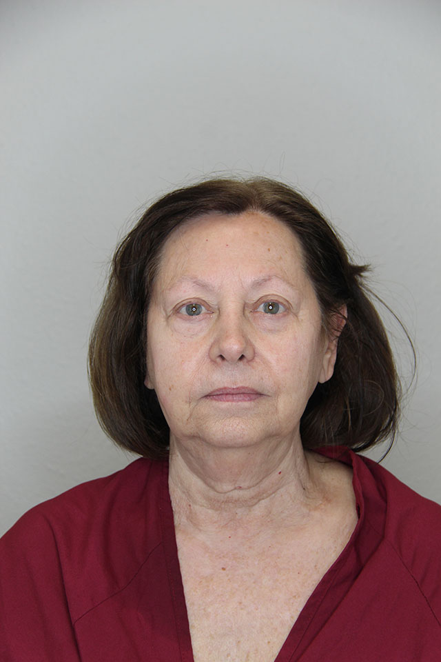 Case--2520 | Before Eyelid Surgery / Blepharoplasty 1