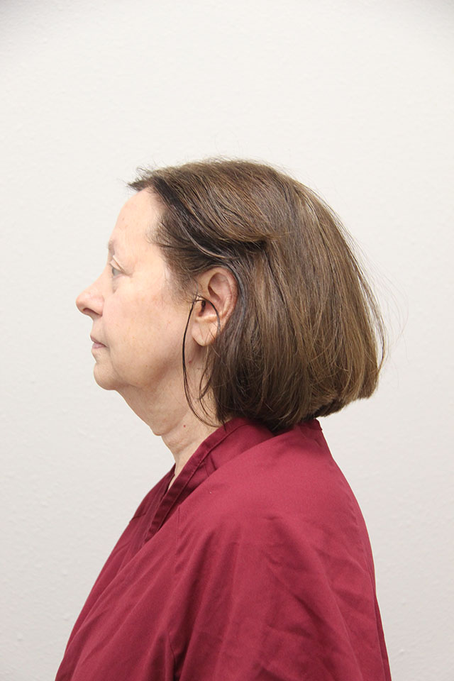 Case--2520 | Before Eyelid Surgery / Blepharoplasty 2