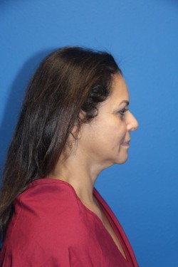 Case--5445 | Before Face 2