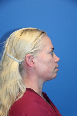 Case--3095 | Before Face 3