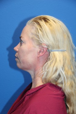 Case--3095 | Before Face 2