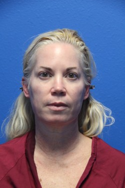 Case--3095 | Before Face 1