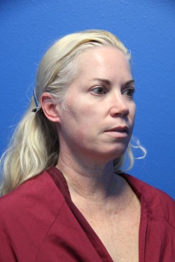 Case--3095 | Before Face 4