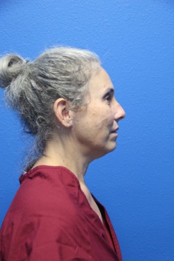 Case--6216 | Before Face 3
