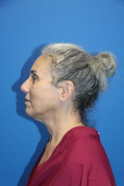 Case--6216 | Before Face 2