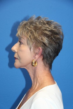 Case--8254 | After Face 2