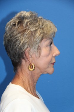 Case--8254 | Before Face 3