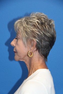 Case--8254 | Before Face 2