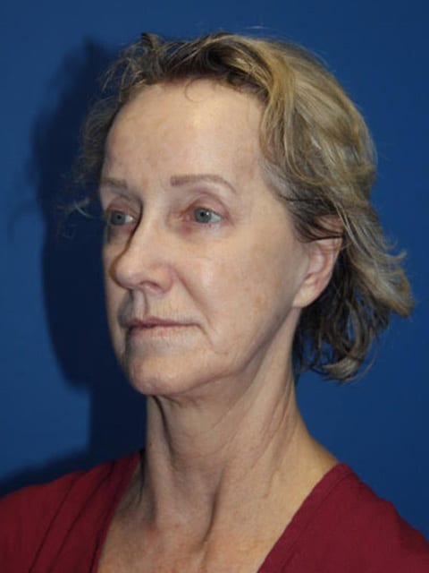 Case--8239 | Before Facelift 4
