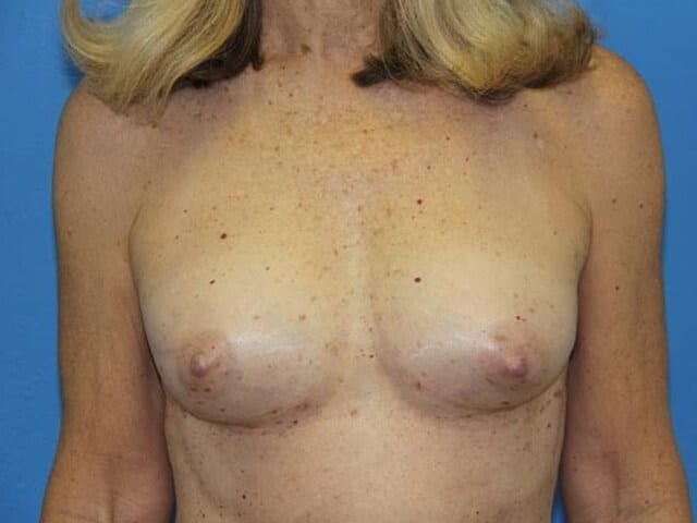 Case--9081 | After Breast Reconstruction with Fat Transfer 1