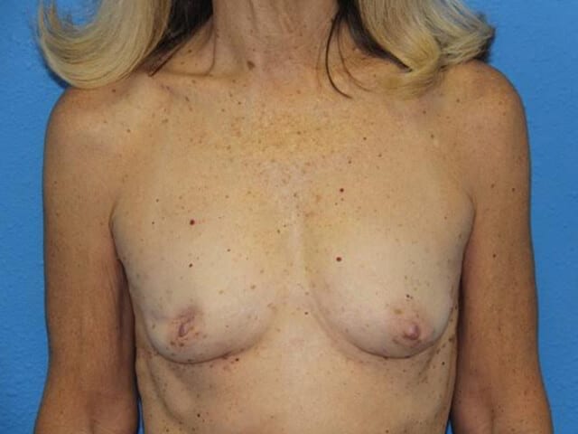 Case--9081 | Before Breast Reconstruction with Fat Transfer 1