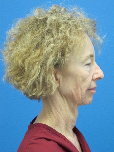 Case--3394 | Before Facelift 3