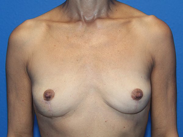 Case--7547 | After Breast Implant Removal and Breast Lift 1