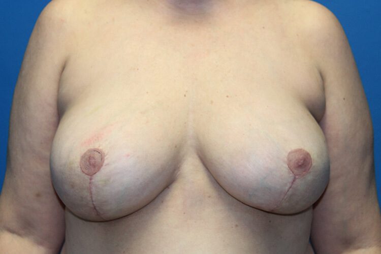 Case--5546 | After Breast Implant Removal and Breast Lift 1