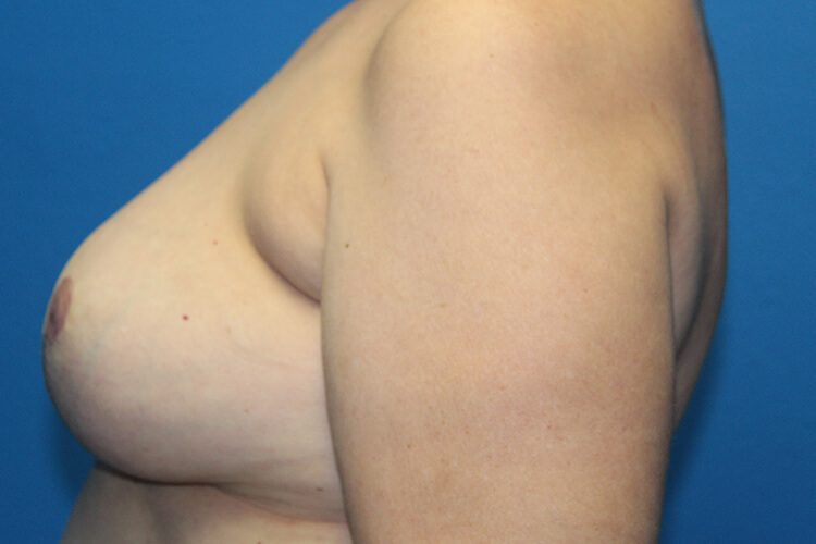 Case--5546 | After Breast Implant Removal and Breast Lift 2
