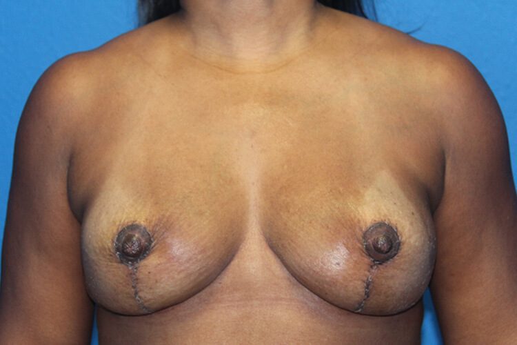 Case--1382 | After Breast Implant Removal and Breast Lift 1