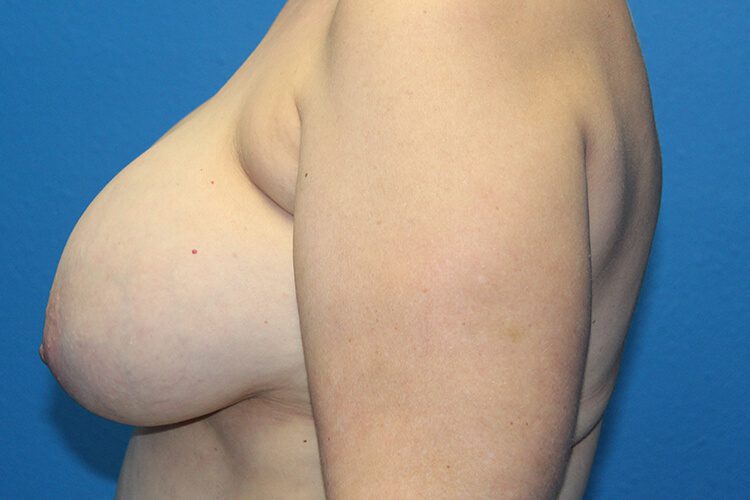Case--5546 | Before Breast Implant Removal and Breast Lift 2