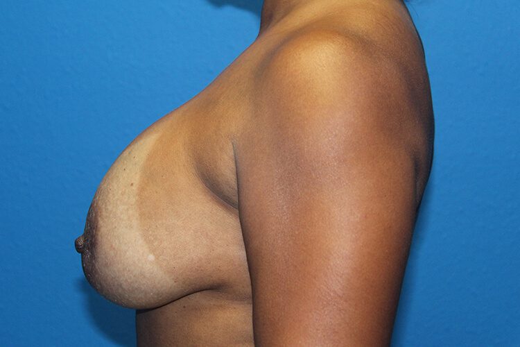 Case--1382 | Before Breast Implant Removal and Breast Lift 2
