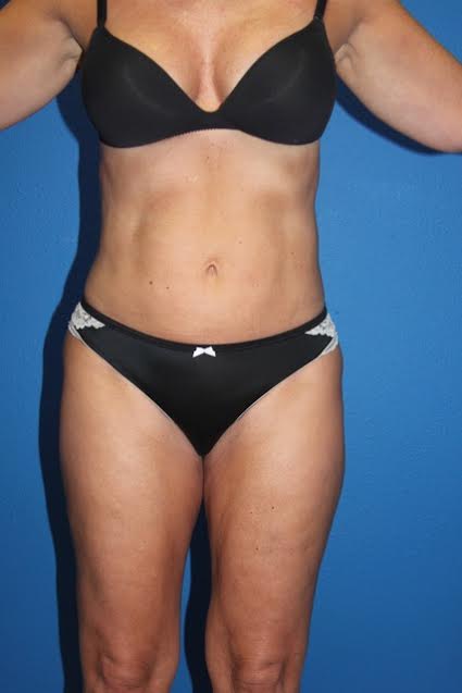 Case--7031 | After Liposuction 1