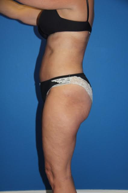 Case--7031 | After Liposuction 2