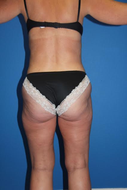 Case--7031 | After Liposuction 3