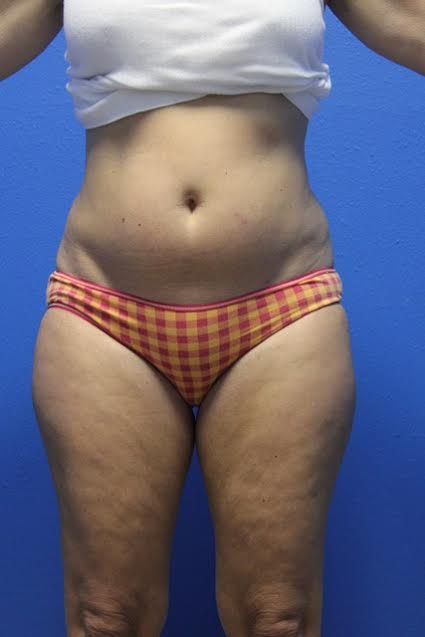 Case--7031 | Before Liposuction 1