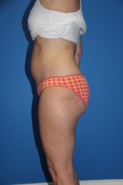 Case--7031 | Before Liposuction 2