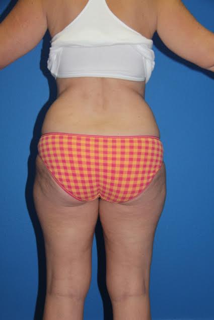 Case--7031 | Before Liposuction 3