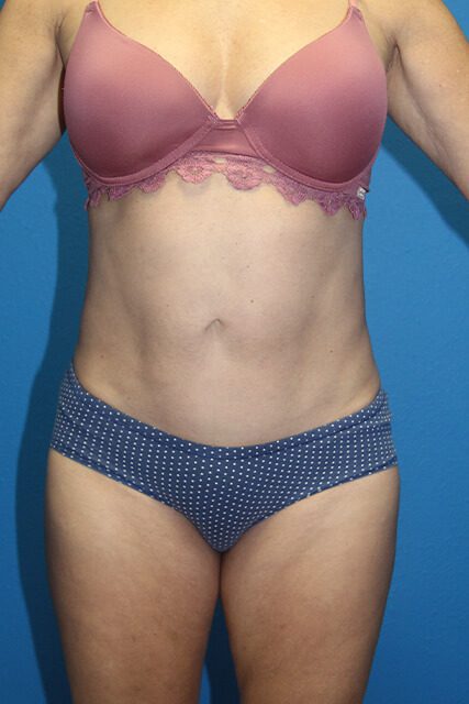 Case--4513 | After Liposuction 1
