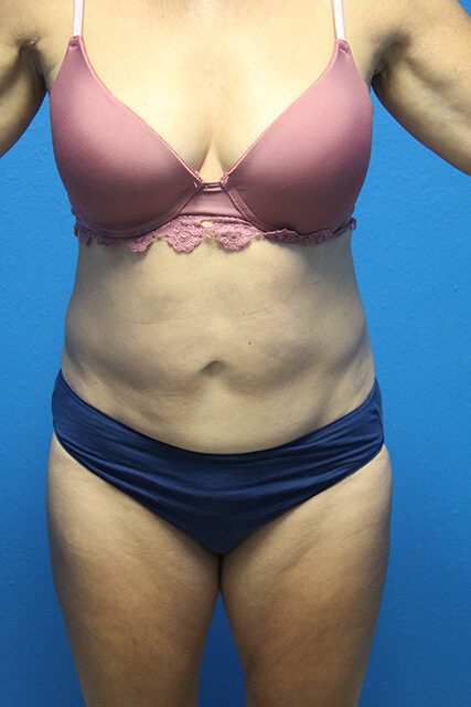 Case--4513 | Before Liposuction 1