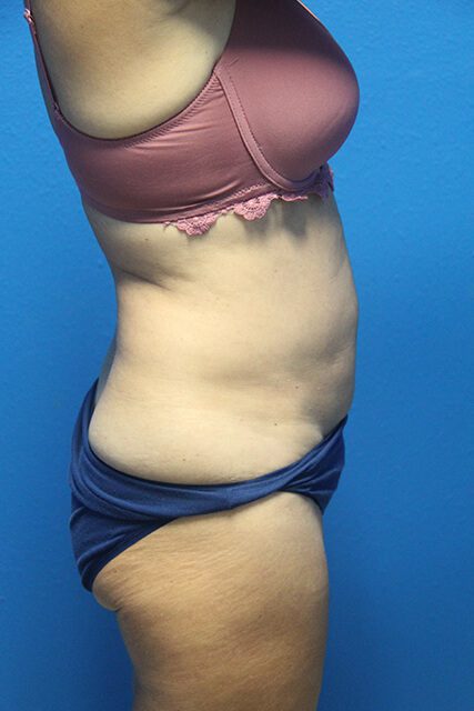 Case--4513 | Before Liposuction 2