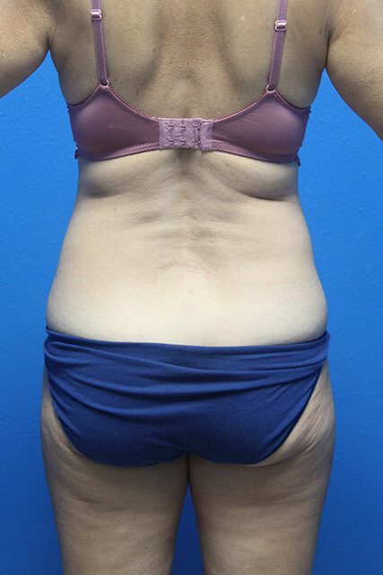 Case--4513 | Before Liposuction 3
