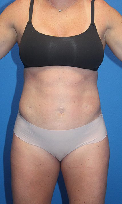 Case--2062 | After Tummy Tuck 1
