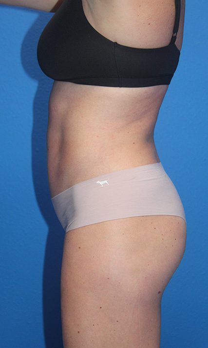 Case--2062 | After Tummy Tuck 2