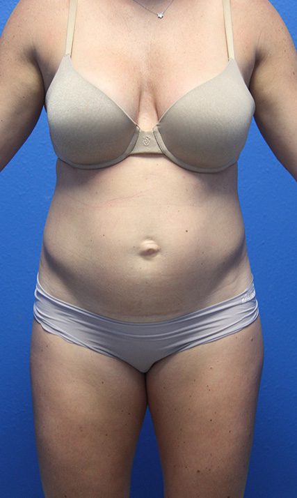 Case--2062 | Before Tummy Tuck 1