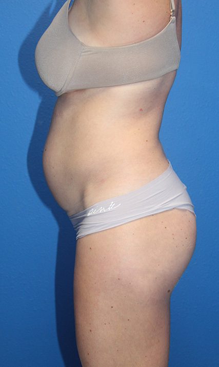 Case--2062 | Before Tummy Tuck 2