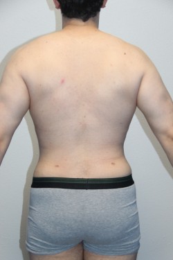 Case--5924 | After Liposuction 4