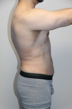 Case--5924 | After Liposuction 3