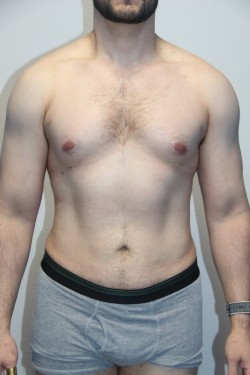 Case--5924 | After Liposuction 1
