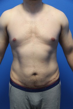 Case--5924 | Before Liposuction 1